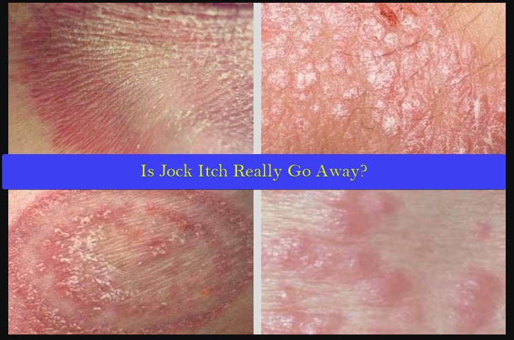 Is Jock Itch Really Go Away