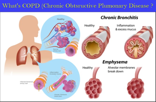 Whats COPD Chronic Obstructive Pulmonary Disease