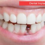 dental implants in Canberra guide on veneers with dental implants