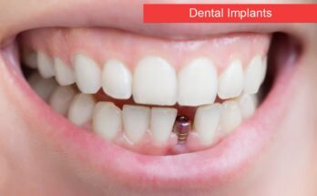dental implants in Canberra guide on veneers with dental implants