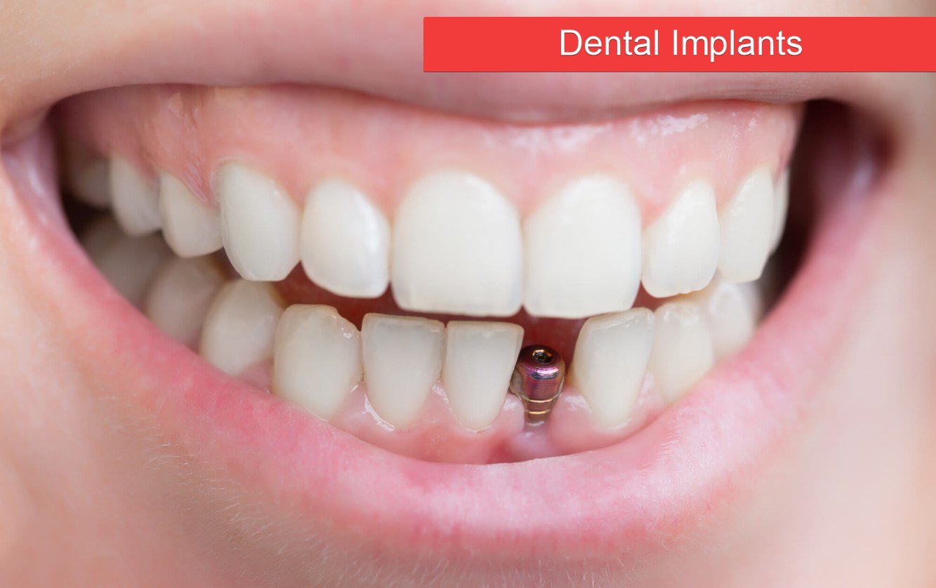 Complete guide on veneers with dental implants