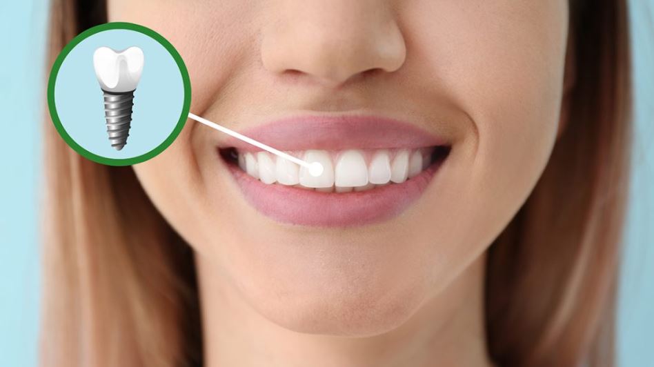 Choosing Dental Implants for a Confident Smile
