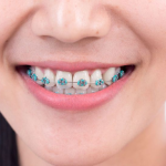 comfort dental braces