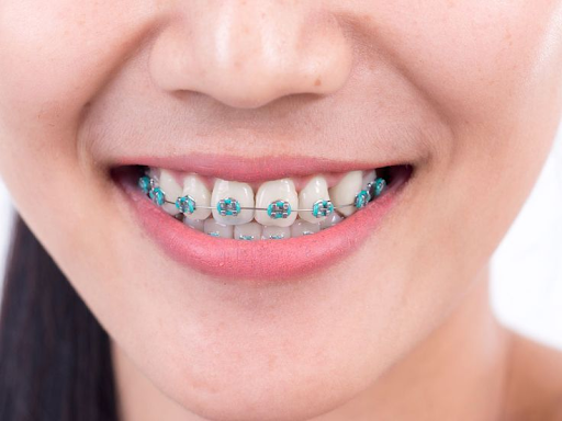 comfort dental braces