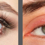 stye treatment spray