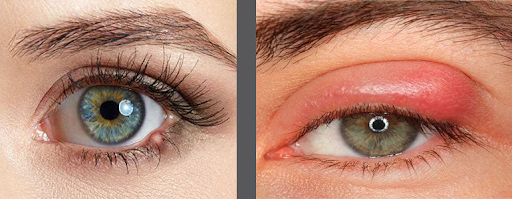 Stye Treatment Spray for Fast, Gentle Relief