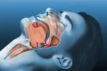 How an Oral and Maxillofacial Surgeon Addresses Sleep Apnoea Through Jaw Repositioning 6 vector sleep apnea