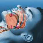 vector sleep apnea