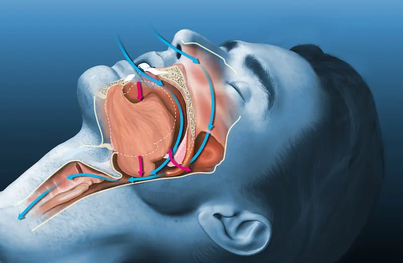 How an Oral and Maxillofacial Surgeon Addresses Sleep Apnoea Through Jaw Repositioning 1 vector sleep apnea